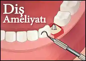 Diş Ameliyatı - 